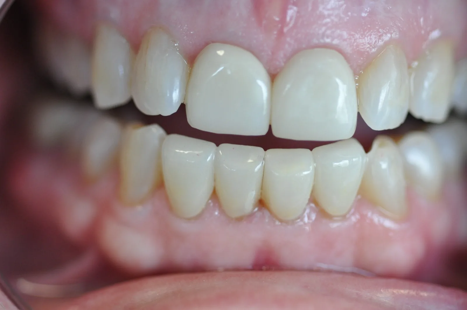 Close-up view of aligned teeth for clear-aligner assessment