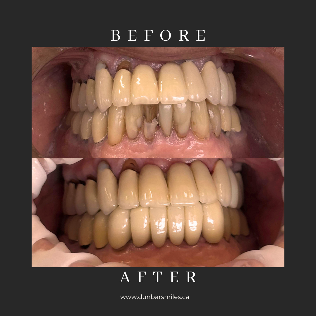 Before and after dental restoration at Dunbar Smiles