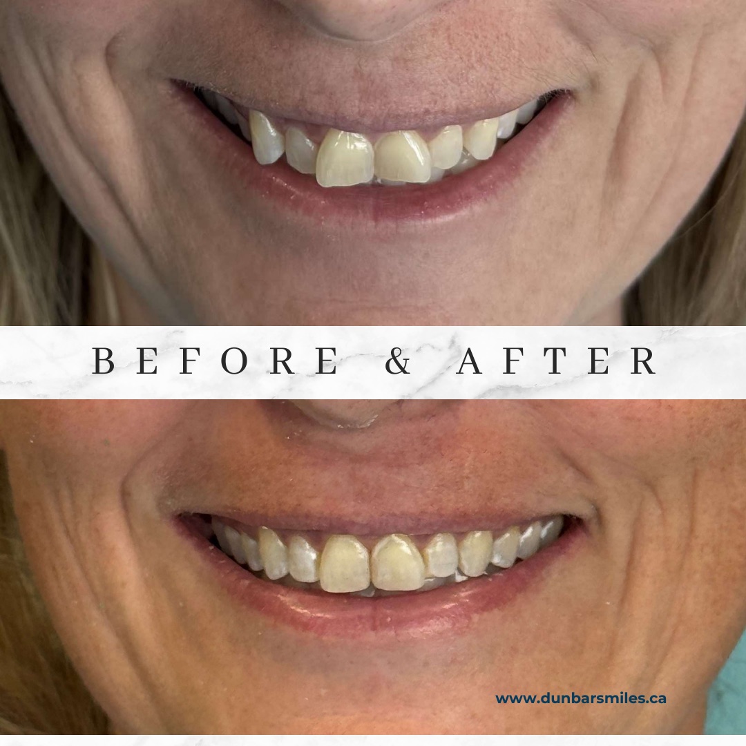 Before and after smile transformation at Dunbar Smiles