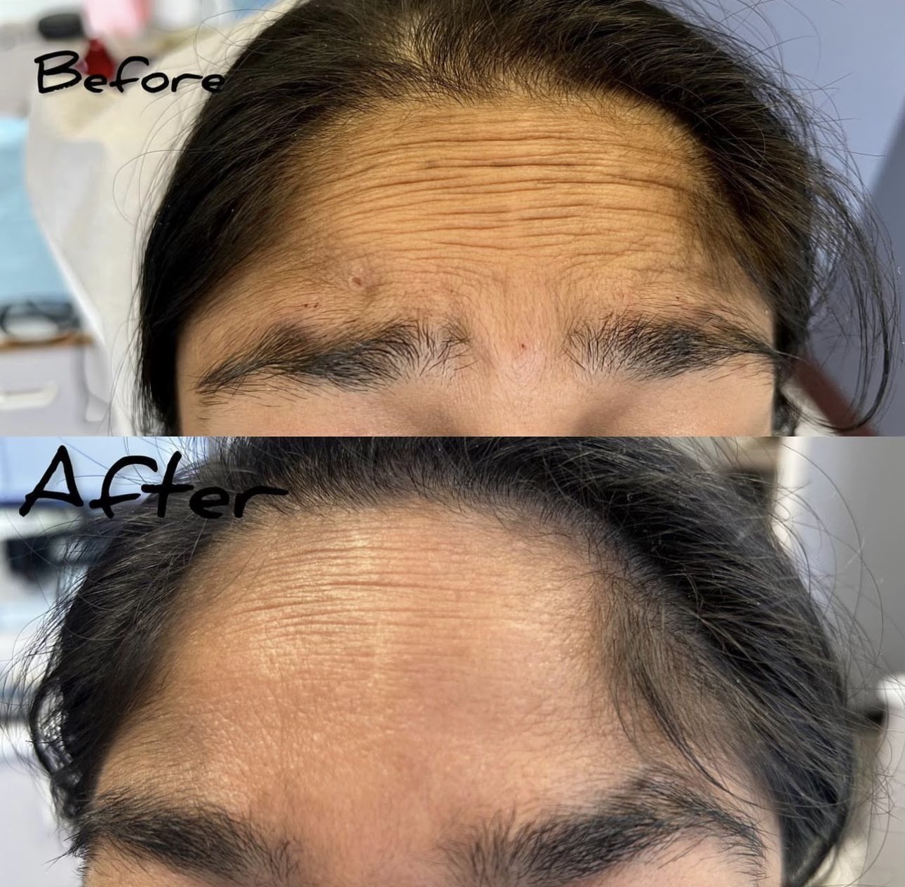 Before and after Botox treatment at Dunbar Smiles