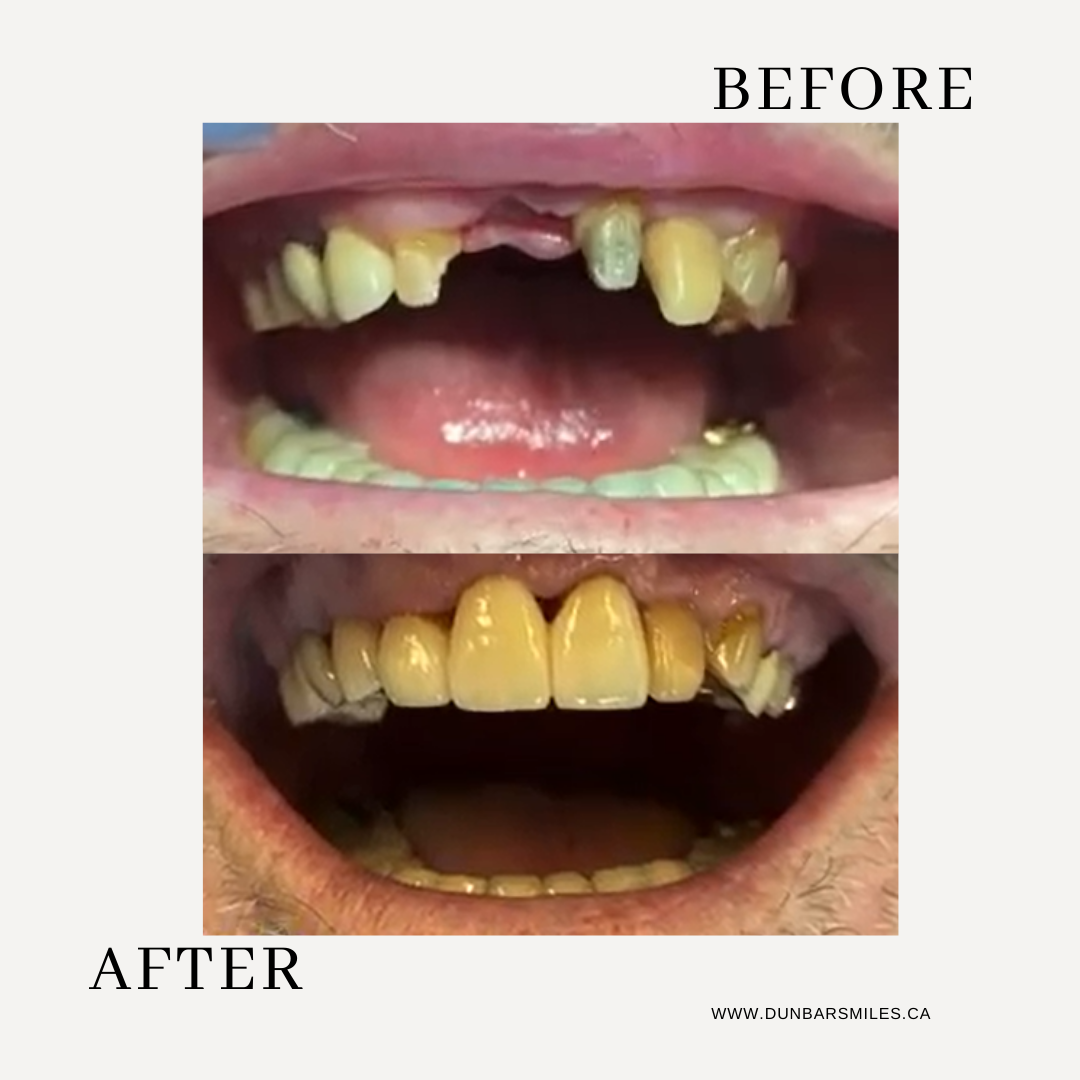 Before and after crown and bridge restoration at Dunbar Smiles