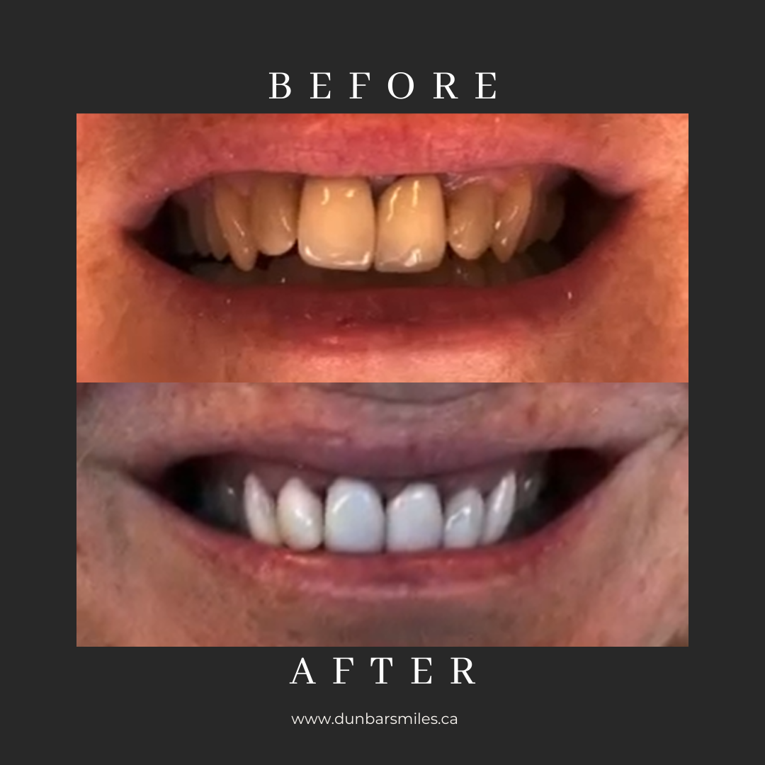 Before and after smile makeover at Dunbar Smiles