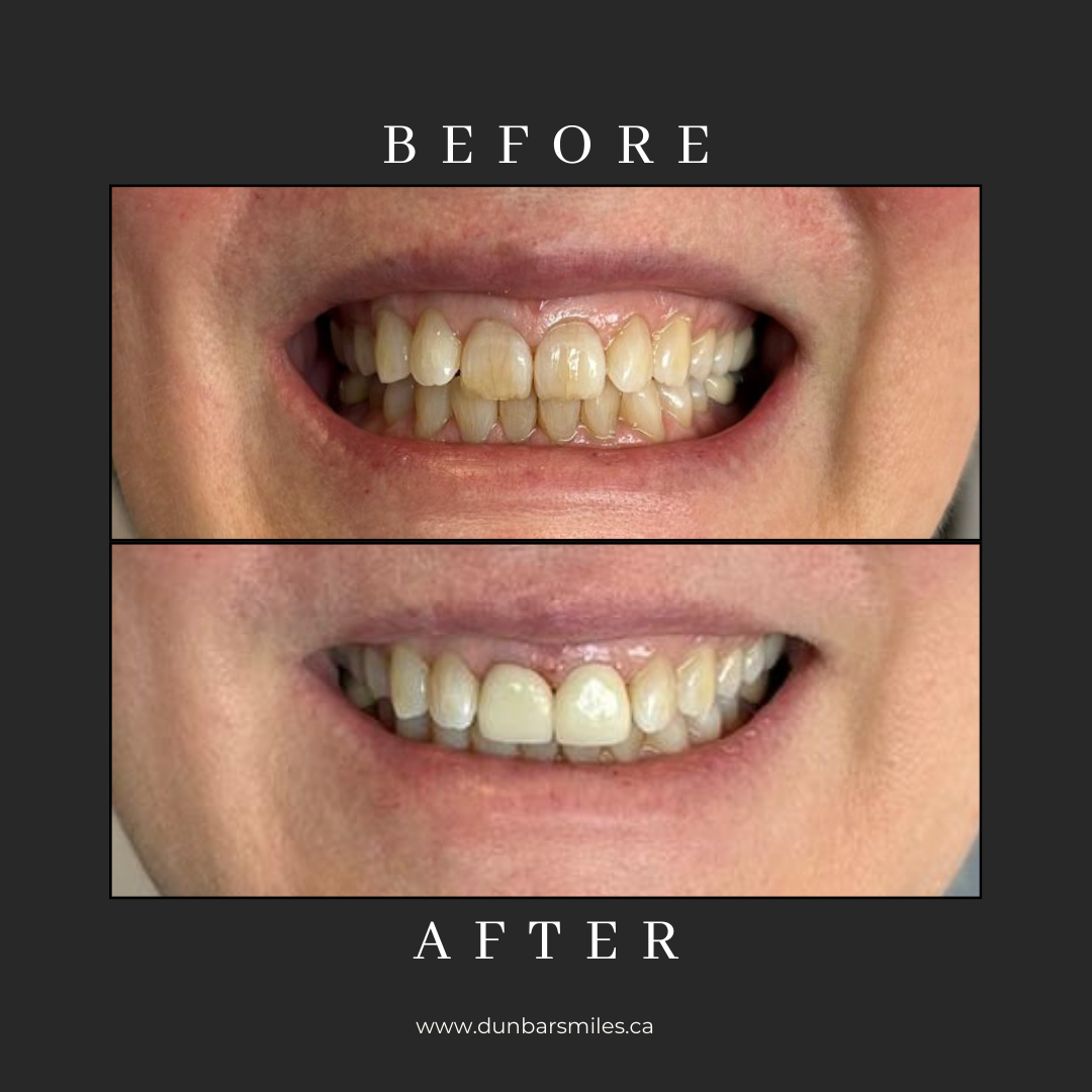 Before and after smile transformation at Dunbar Smiles