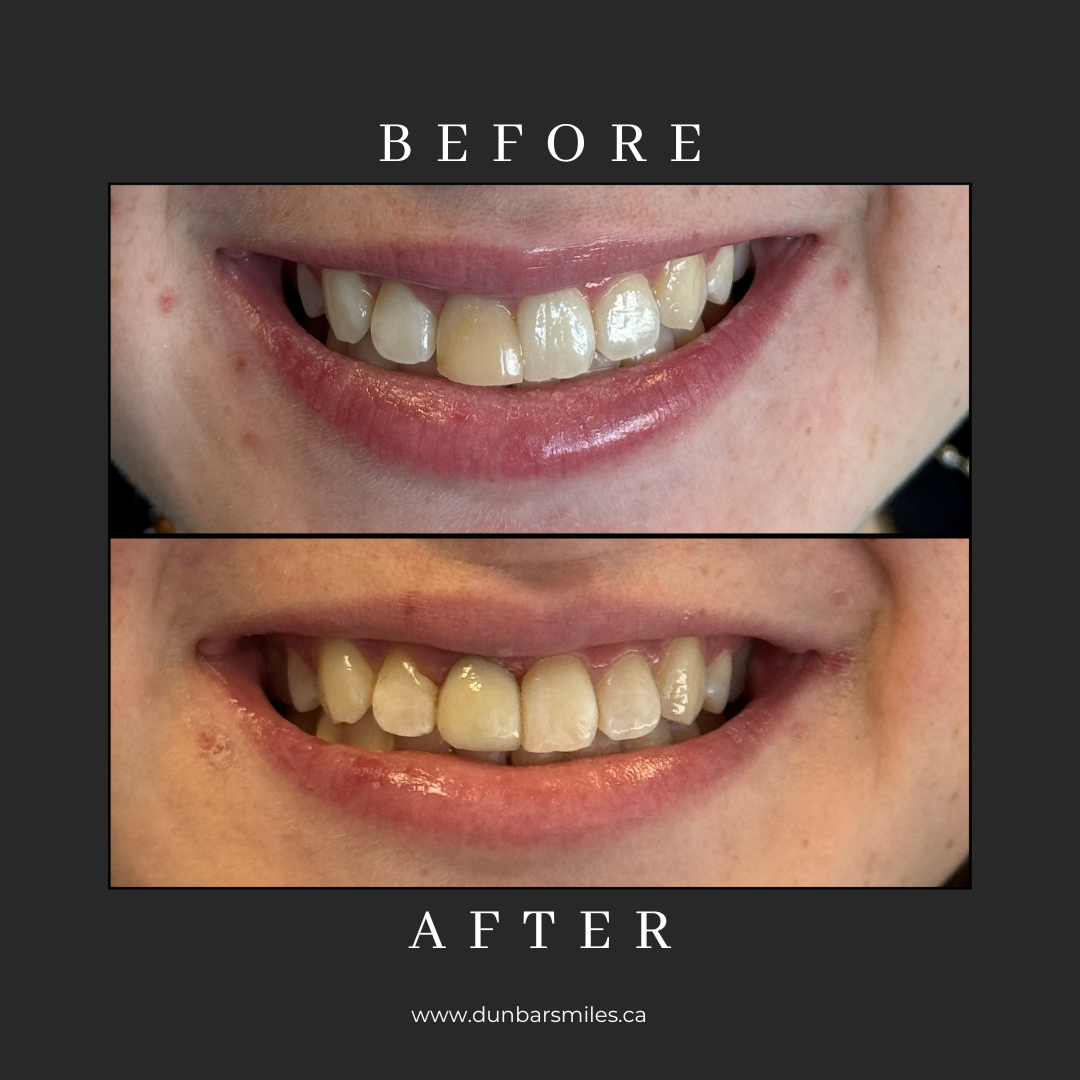 Before and after smile makeover at Dunbar Smiles