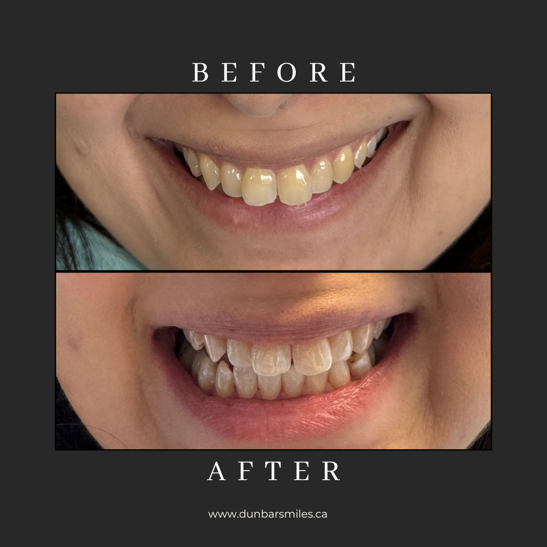 Before and after cosmetic smile enhancement at Dunbar Smiles