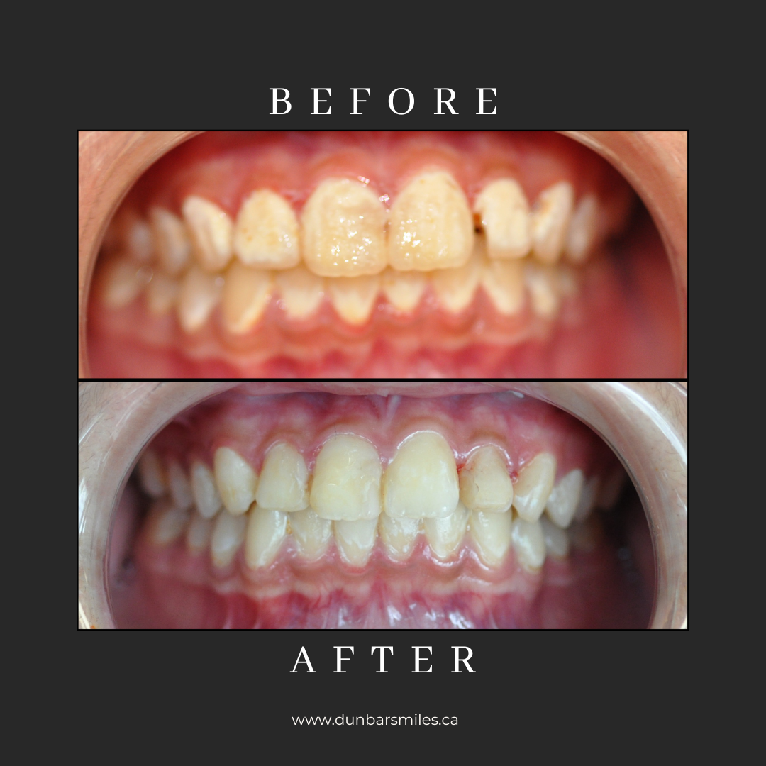 Before and after smile transformation at Dunbar Smiles