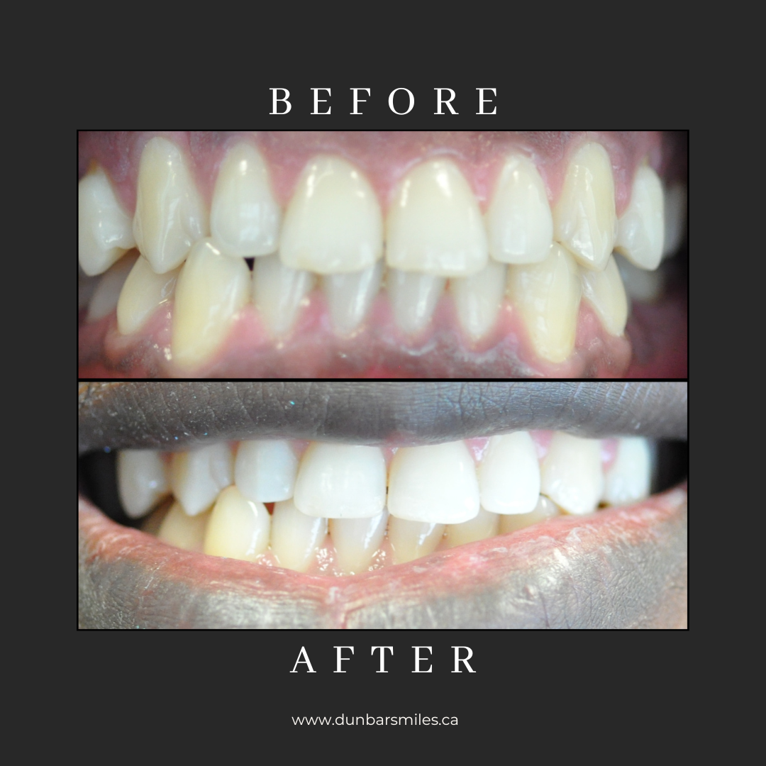 Before and after smile transformation at Dunbar Smiles