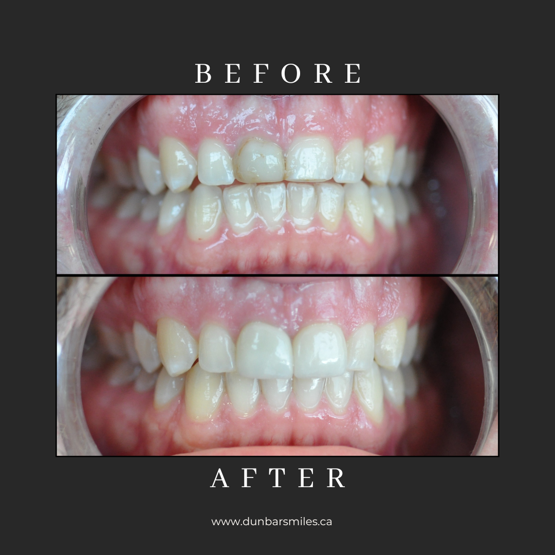 Before and after tooth restoration at Dunbar Smiles