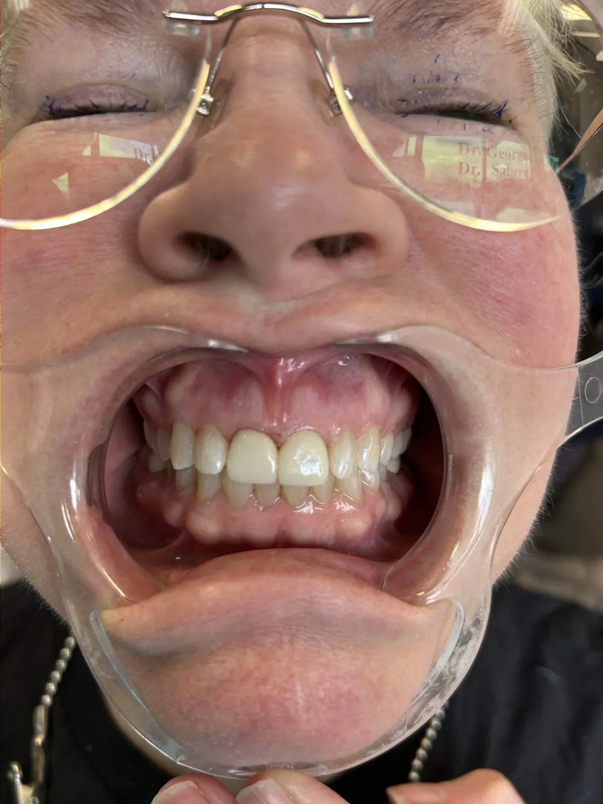 An Invisalign and smile review consultation