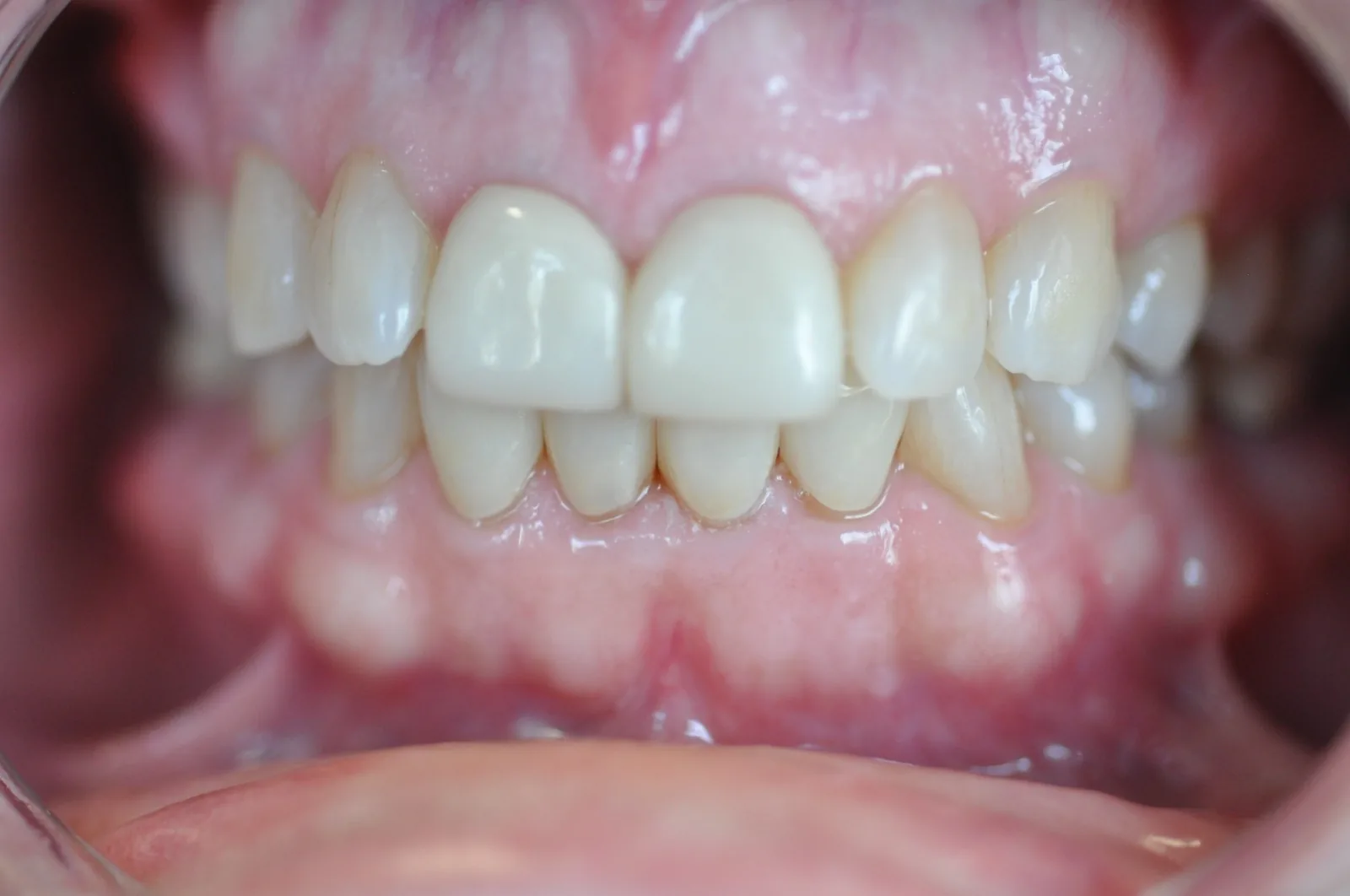 Close-up dental view used in restorative assessment