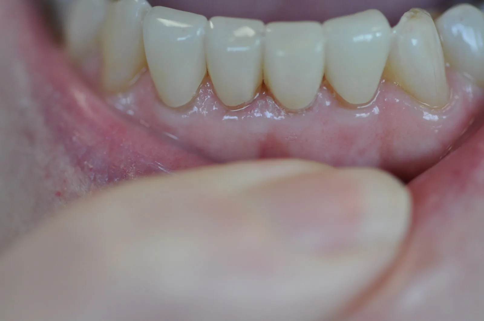 A close-up image showing tooth wear and sensitivity concerns
