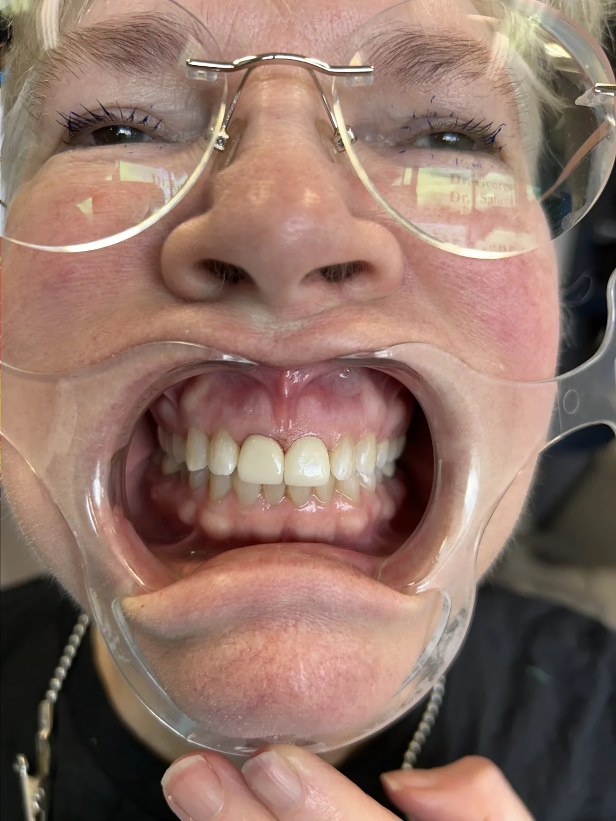 Close-up smile after cosmetic dental treatment